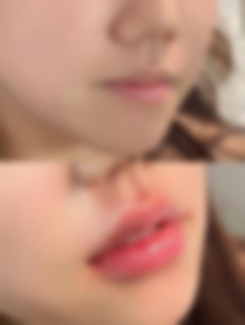 去眼袋暗藏哪些风险？揭秘下睑外翻/眼睑退缩问题及应对方式