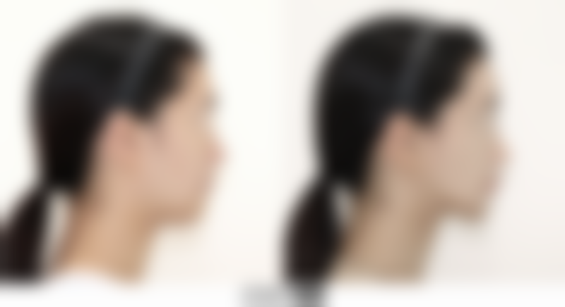 进口假体隆胸能否恒久？个体差异要考虑