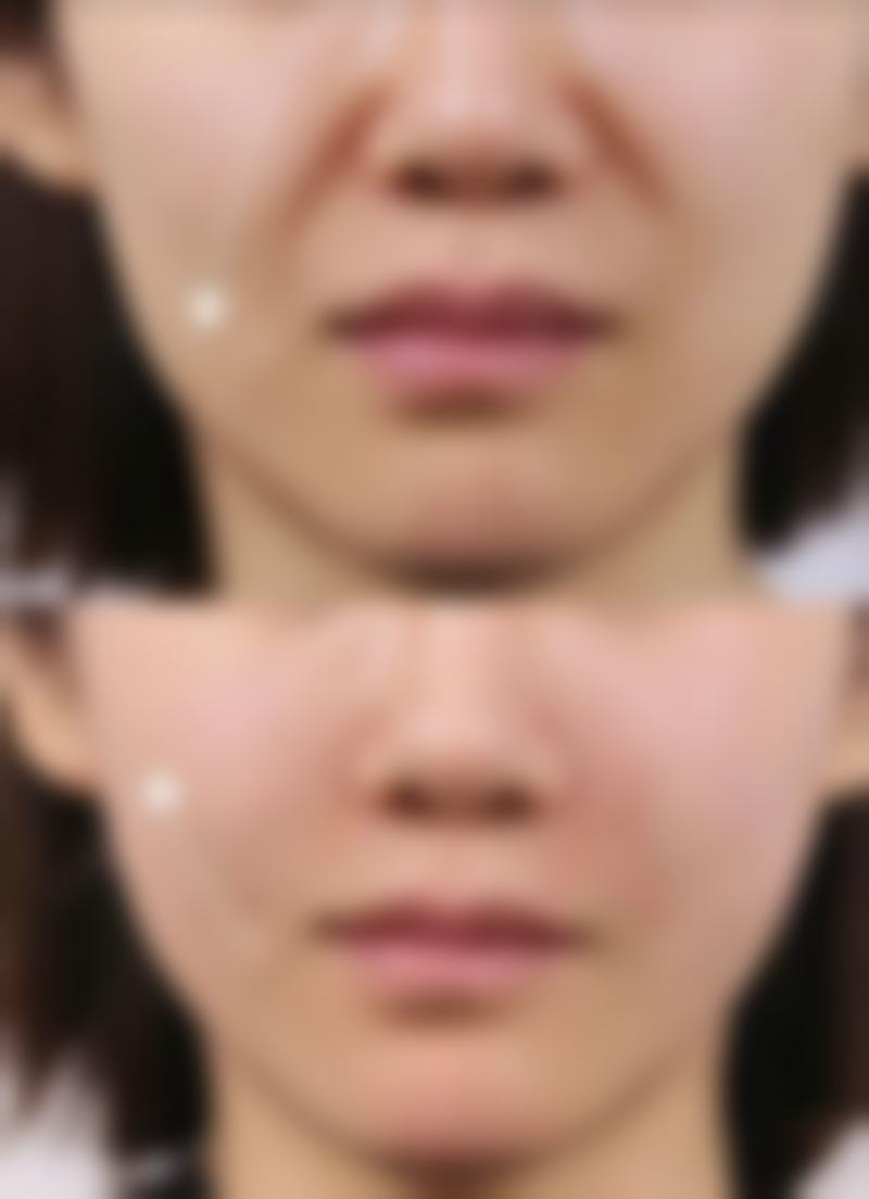 光子嫩肤后疤痕反黑别怕！知晓修复情况心不慌