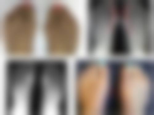 凹陷性疤痕修复方法有哪些？手术治疗来帮忙