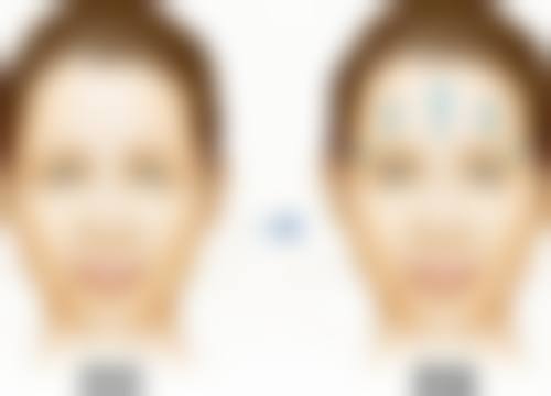 为何双眼皮悄然变三眼皮？衰老与退行性变是主因