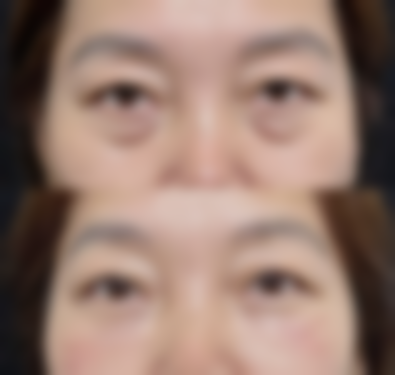 吸脂全麻对脏器负担的影响