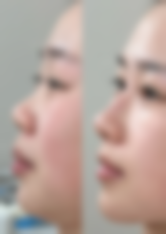 凹陷性疤痕修复方法有哪些？非手术治疗显神通