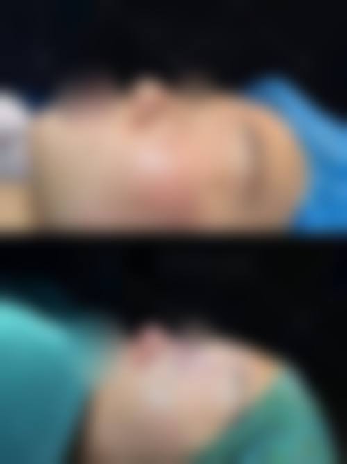 五、苏州澳美整形医院实例