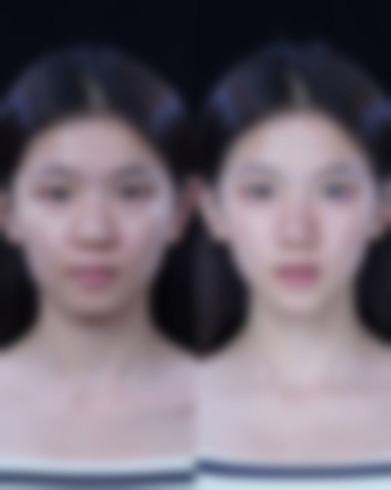 哪种瘦脸针堪称至佳之选？精细选对适合自己的瘦脸针