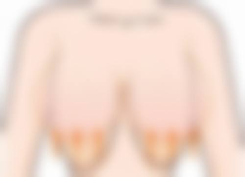 开双眼皮暗藏哪些风险？瘢痕增生问题及应对策略揭秘