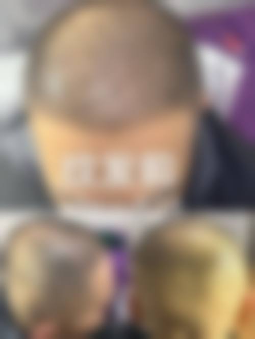 六、清远雍禾植发医院怎么预约：