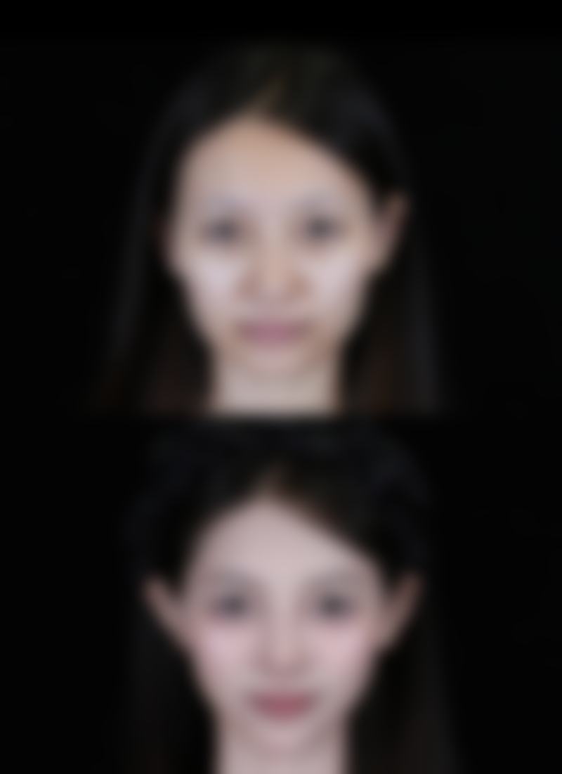 宝俪隆胸假体究竟好不好？长保效期让人放心