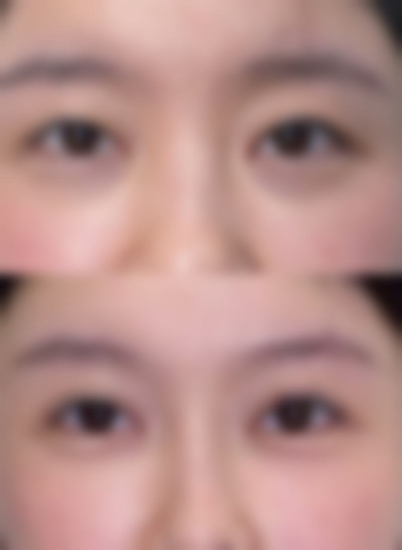 烧伤疤痕究竟能否消除？多方法综合治疗助力淡化改善，更有植发技术覆盖瘢痕 