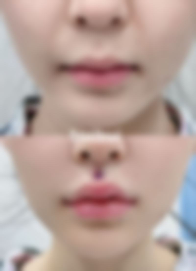 宝俪隆胸假体究竟好不好？多样型号满足不同需求