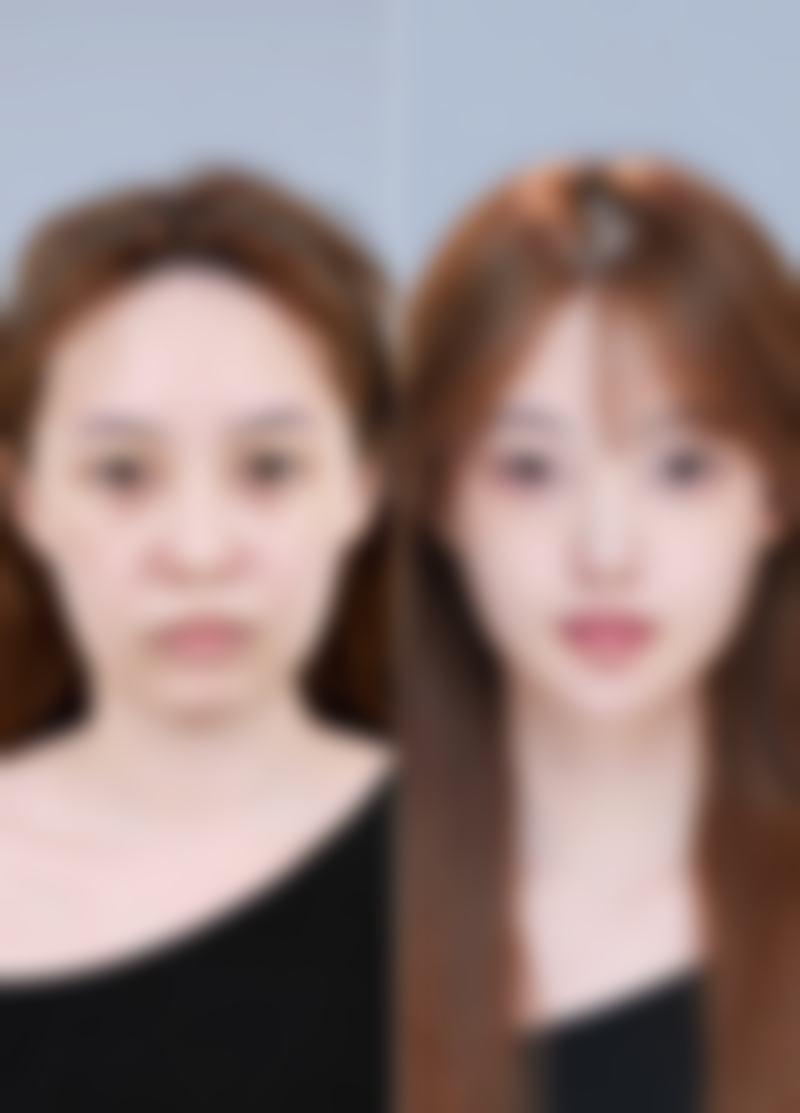 瘦脸针剂量怎么保？其他相关说明巩固成效
