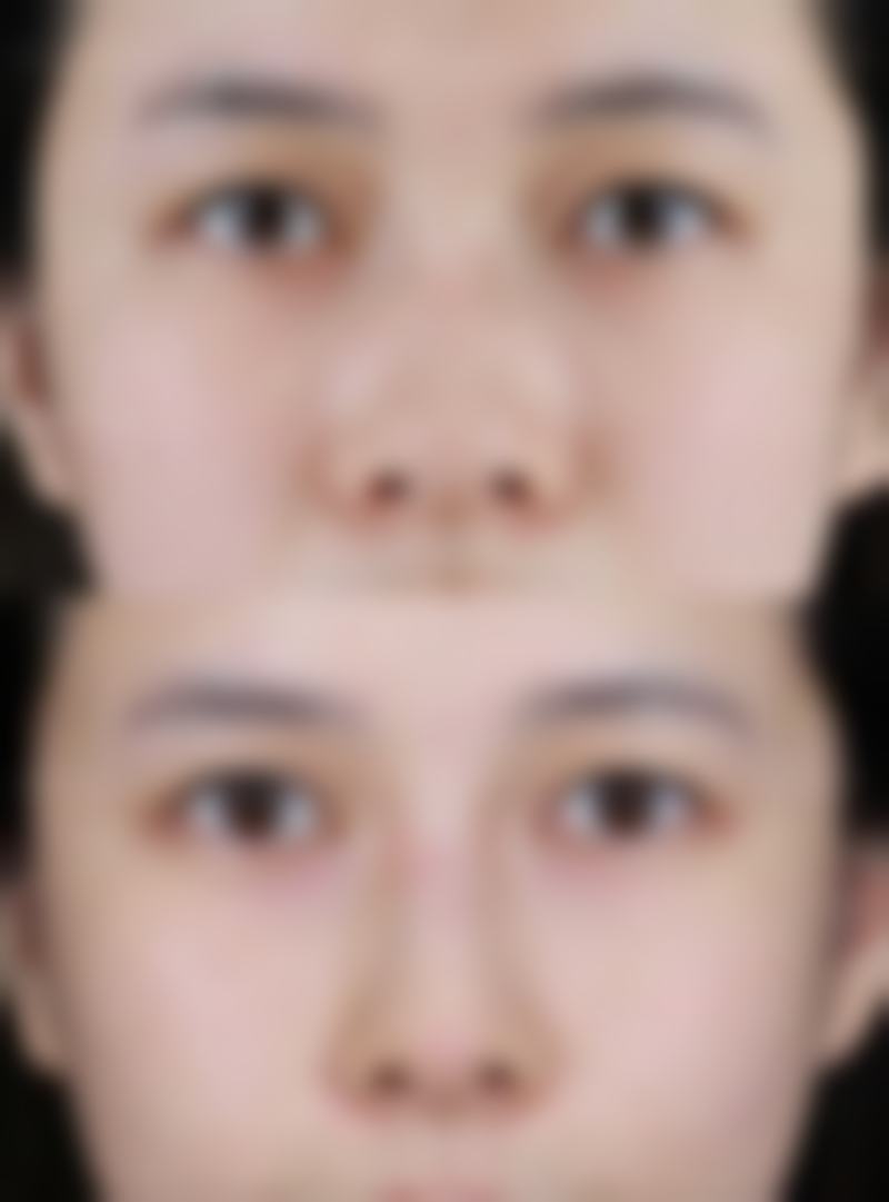瘦脸针剂量怎么挑？影响因素决定个性方案