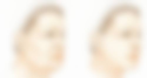 80单位瘦脸针打两边：专精操作更放心