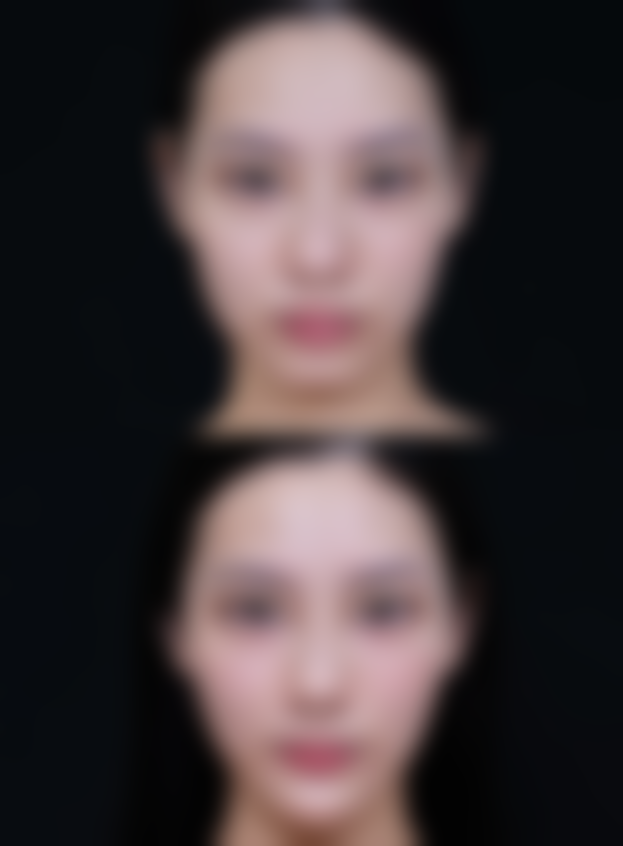 怎样快速搞定疤痕疙瘩？多种疗法联合+术后护理，实现疤痕疙瘩修复改善 