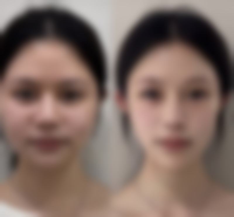 物理治疗加速淡红色疤痕转变