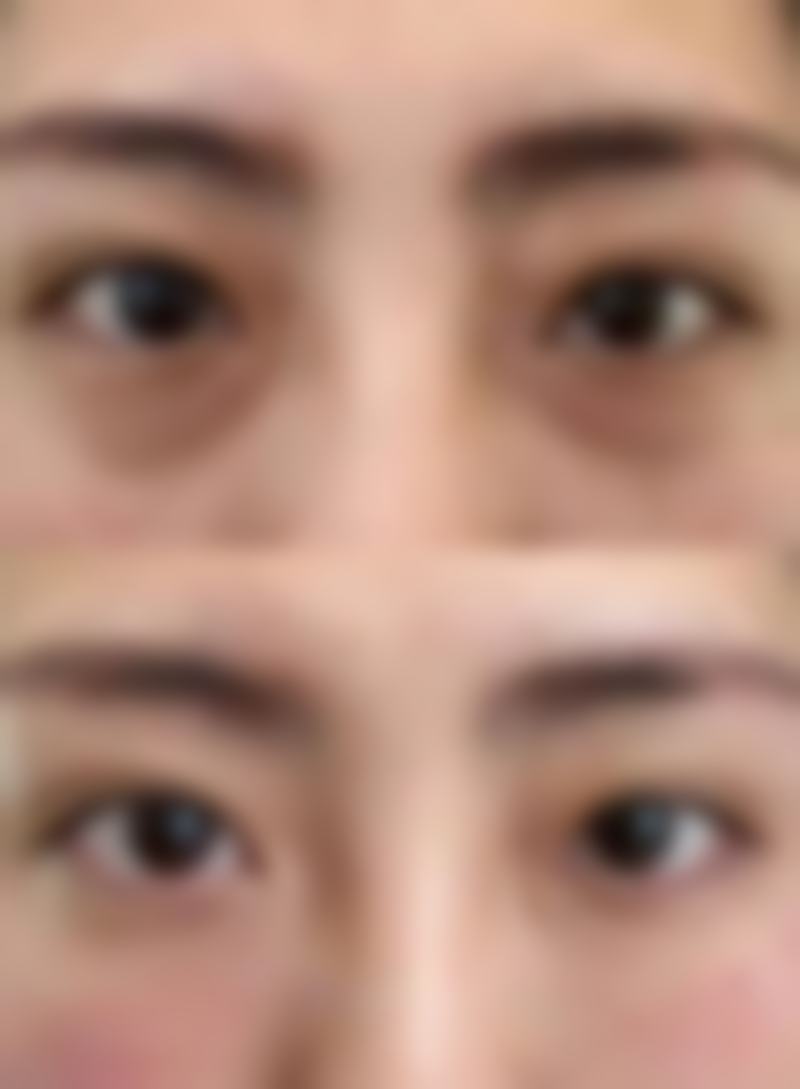 淡红色疤痕如何变回肉色？多种方法助你淡化疤痕，加速恢复自然肤色 