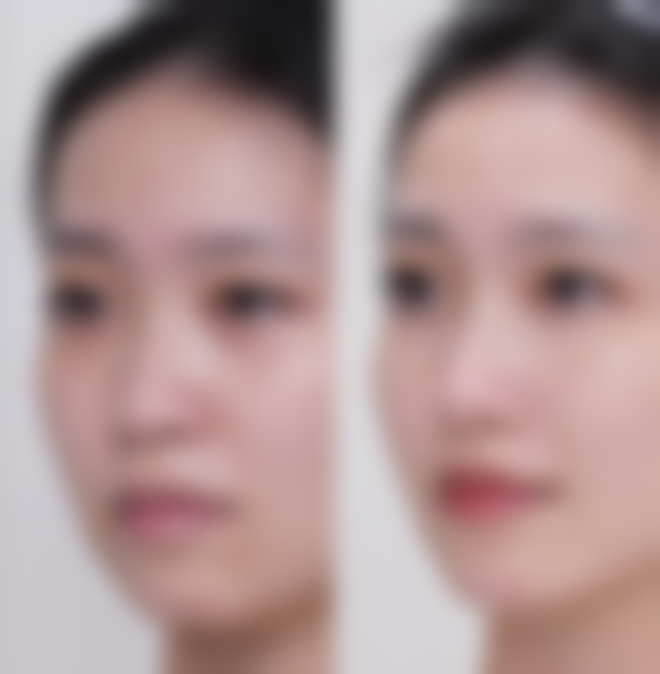 怎样去除下眼袋下眼纹？光电/仪器及手术治疗有妙招