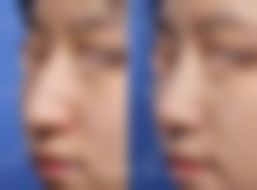 五、成都御美汇整形医院实例