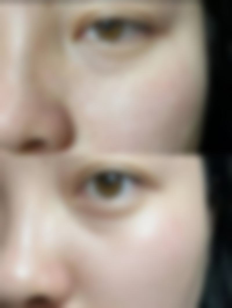 不同精细化雕刻双眼皮术式的适合人群与优势