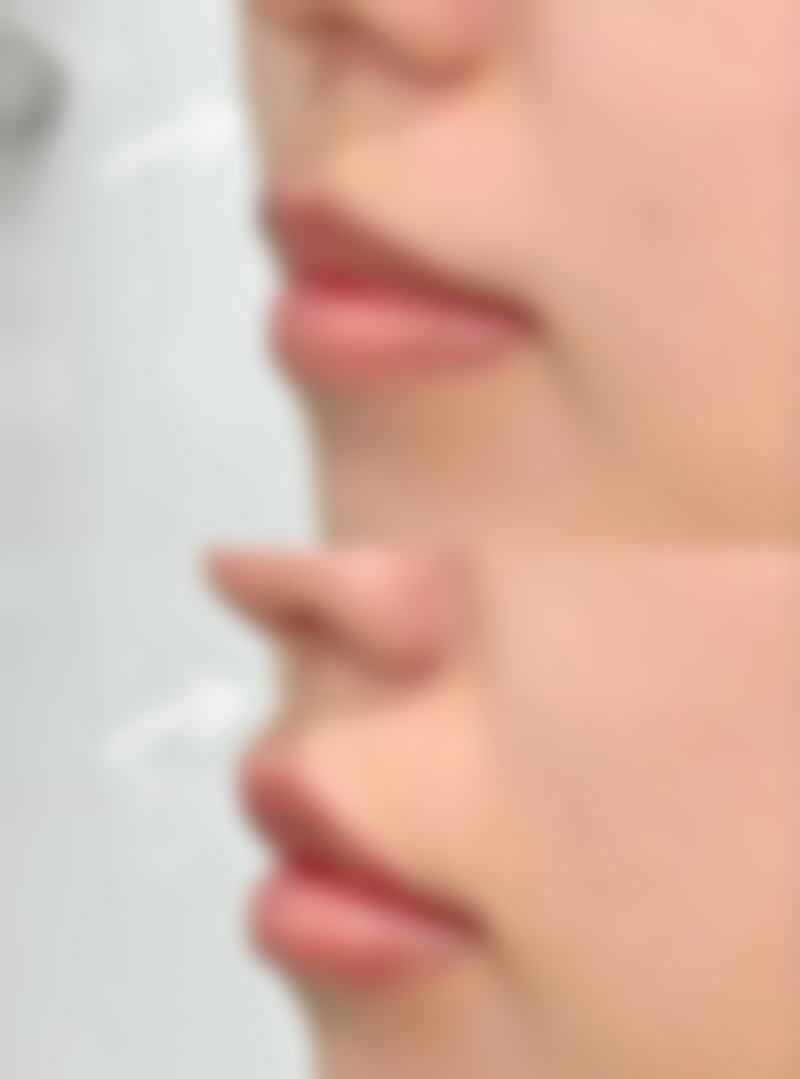 硅胶假体隆胸究竟能保存多久？受材质、护理等因素影响，最长竟可终身保留！ 