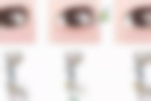 假体隆胸后胸部外扩如何修复?非手术治疗来帮忙