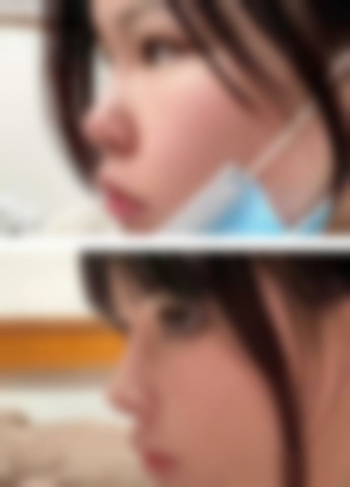 不同祛痣方式后疤痕多久能修复?