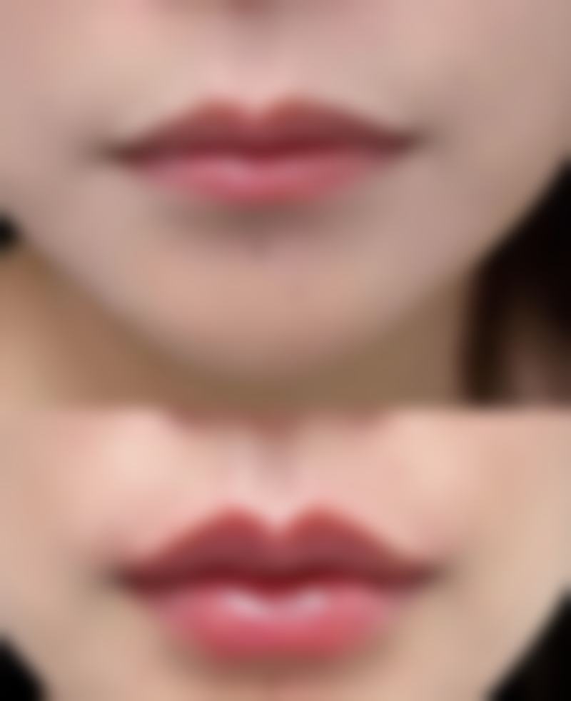 刚出生小孩能否割双眼皮？治疗性可行，美容性建议待高考后眼部定型再手术 