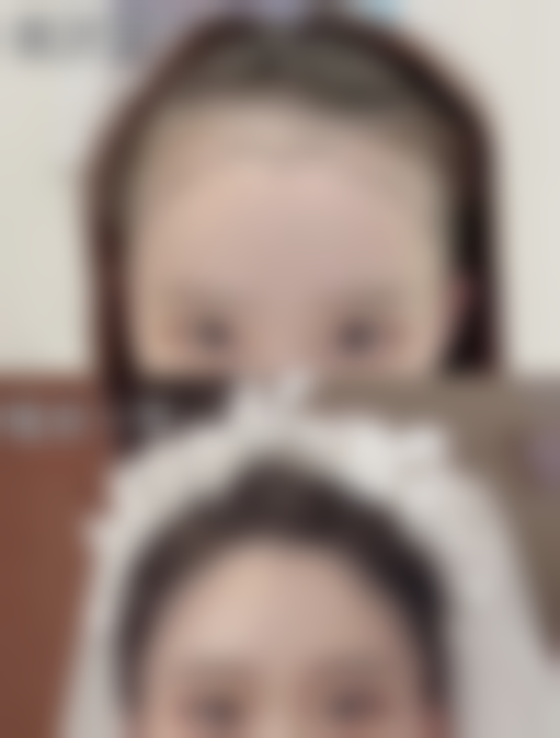做双眼皮可能出现的后遗症之上睑下垂