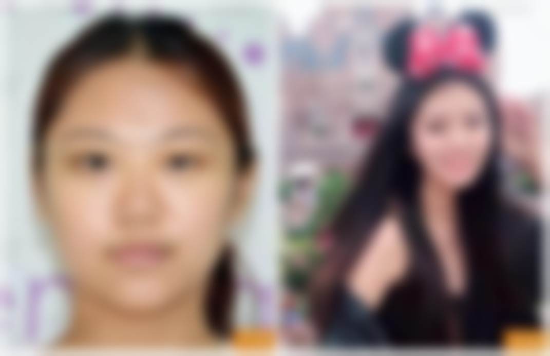 北京禾美嘉医疗美容门诊部黄金热拉提2.0临床应用反馈