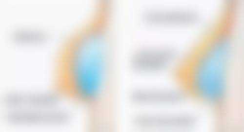 割双眼皮后吃木瓜柠檬等水果,辅助修复成效佳