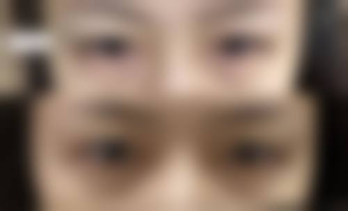 黑眼圈眼袋大究竟为何?疾病与健康问题来“捣乱”