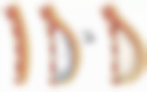 影响转归的因素：多种因素决定疤痕走向