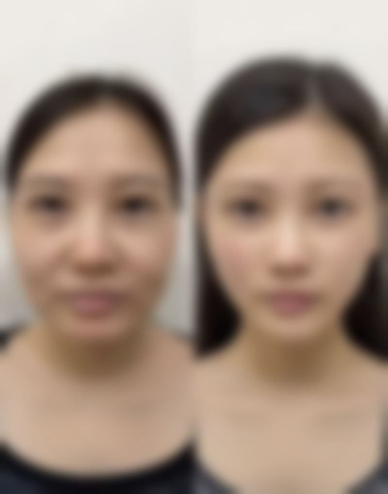 运动时隆胸与真胸的外观差异