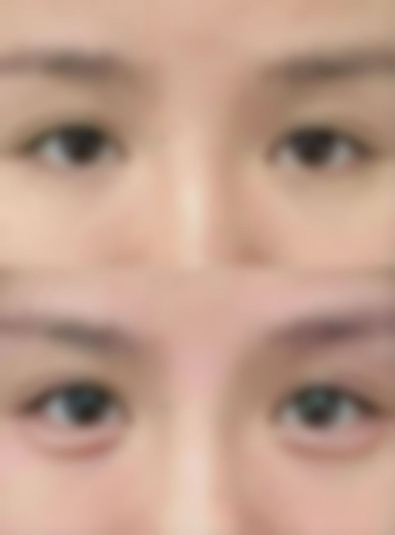 阴道紧缩术后多久能同房？综合多因素考量，合理时间助力恢复与优质性生活 