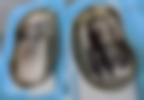 如何选对双眼皮术式和形态？依据个人条件与需求，适配专属你的理想美眼方案 