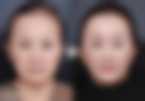 隆鼻两年被撞影响几何？揭秘不同撞击程度后果及科学处理、防护方案 