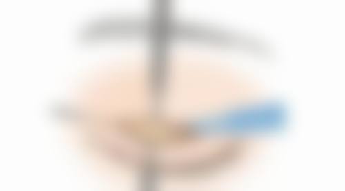做韩式双眼皮需留意啥?术中配合医生操作特别关键