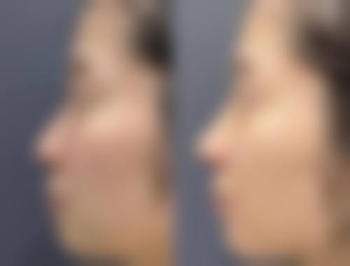 如何按摩眼睛消眼袋?穴位按摩显神通