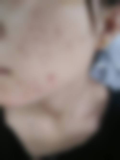 三、建瓯市疾病预防控制中 心皮肤病性病防治院医生介绍: