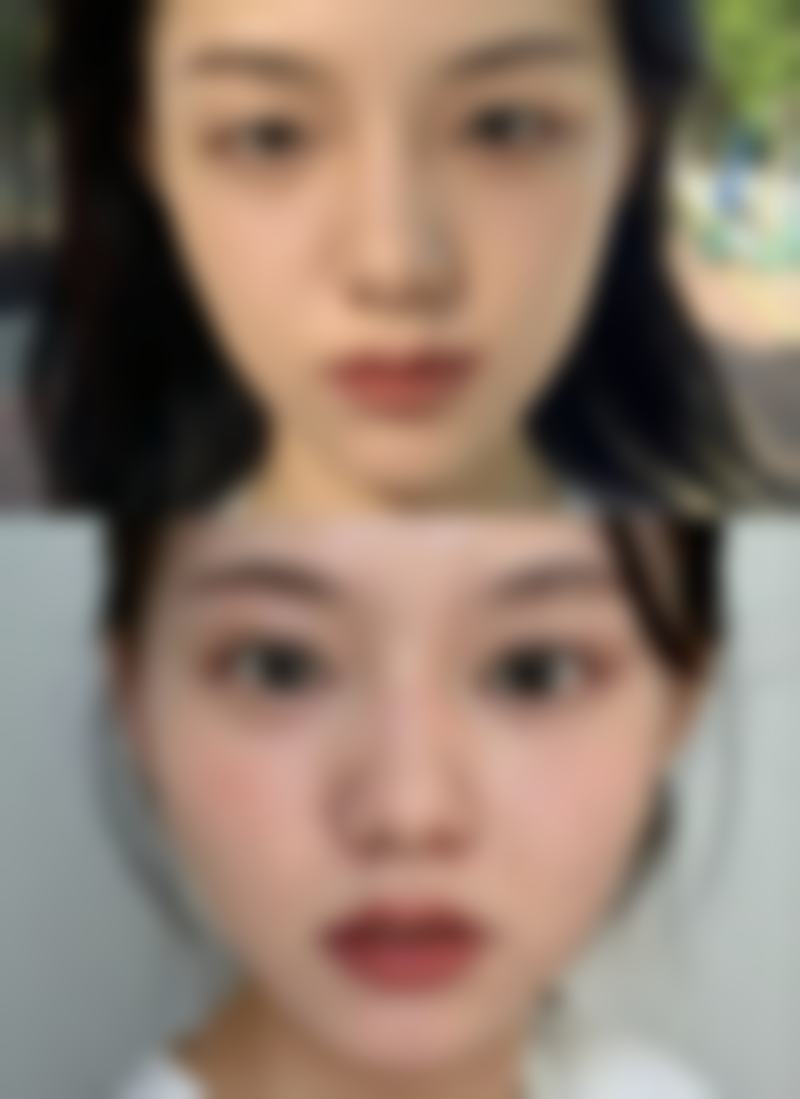 五、韩国丽儿整形医院实例