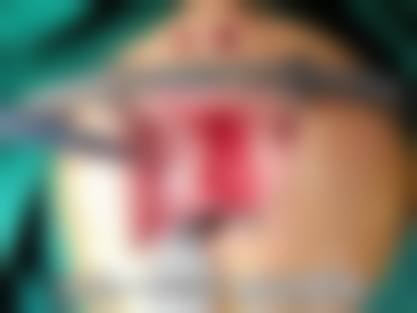 五、成都正美整形医院实例