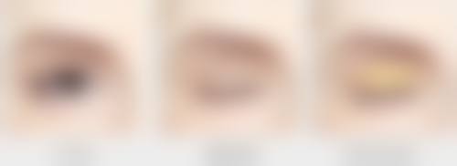 想知道自己是否为疤痕体质？从家族史、瘢痕表现等多维度精准判定！ 