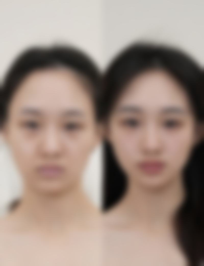 没有双眼皮贴,手术变身双眼皮之埋线法