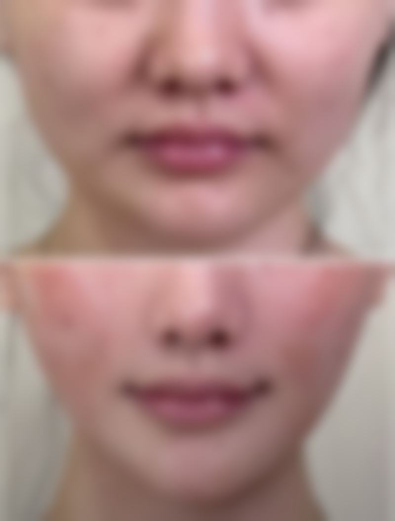 上眼皮厚选双眼皮手术:不建议优先选的术式——埋线双眼皮
