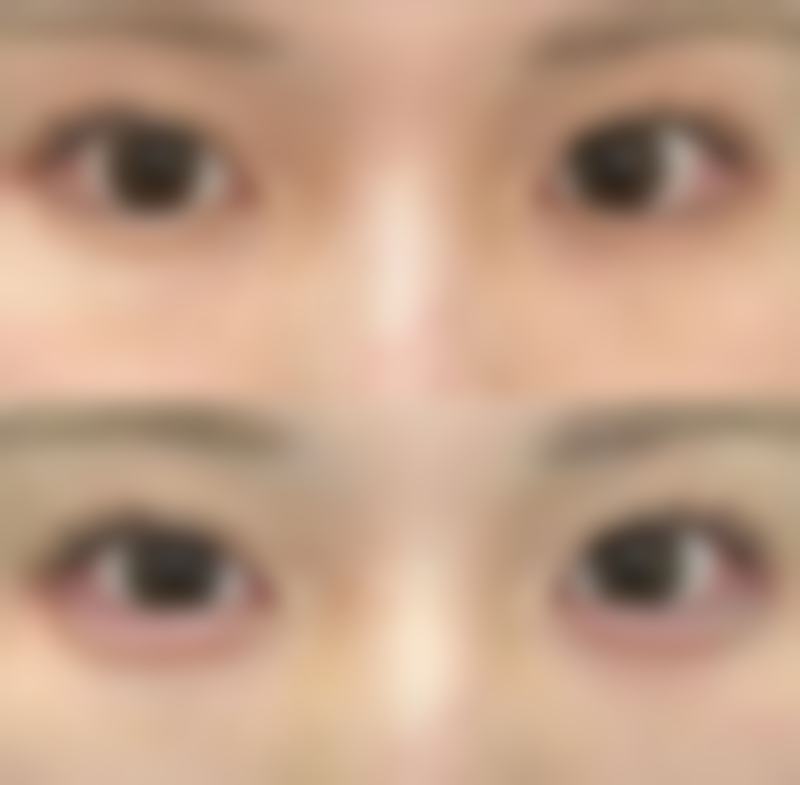 上眼皮厚选双眼皮手术:精细之选——Park双眼皮