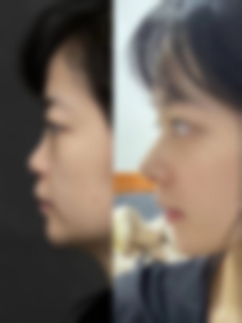 五、杭州柏思颜整形医院实例