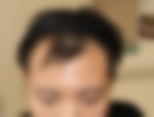 五、重庆新生植发医院实例