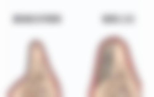 种植头发暗藏的瘢痕与肿胀危害:形成原因及解决办法