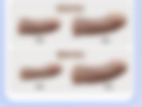双眼皮手术拆线后碰水:饮食与异常处理