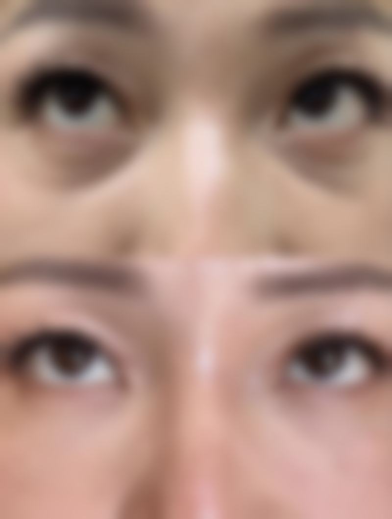 瘦脸针和下巴针一起打,节省时间和成本